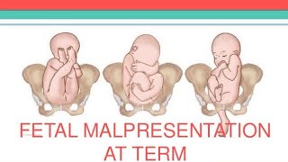 Mechanism of breech presentation in extended arms