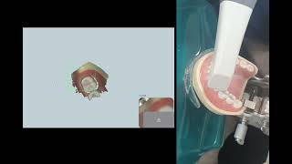 Digital Impression ( Intraoral Scanner )