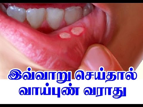 Tamil health tips _ Vaai Pun ( mouth ulcer) _ இவ்வாறு செய்தால் வாய் புண் வராது