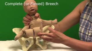 Breech Births - for Midwives
