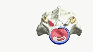 HumanTech: ADONIS Transforaminal Lumbar Interbody Fusion