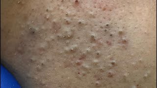 Deep Cleanse Your Face for Clear Skin | Acne, Blackheads, and Whitehead Removal