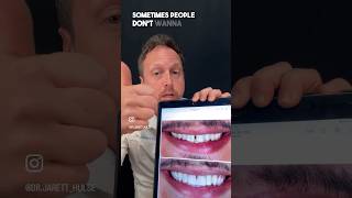 Space closure with Bioclear Composite Veneers #bioclear #compositeveneers #cosmeticdentist #veneers