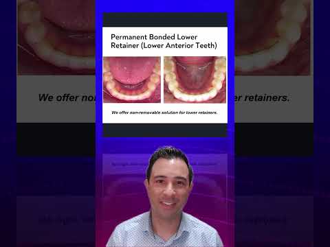 The Benefits of Permanent Lower Retainer Wires