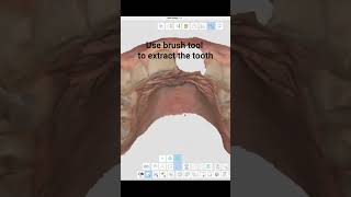 Digital extraction