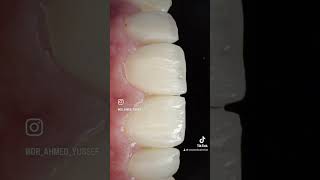 Cerec ceramic crowns with digital impression and aesthetic rehab #dental #dentist #dentistry #تجميل