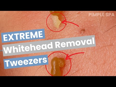 This Blackhead Removal Changed the Way I See Myself Forever (Voice) |Pimple Spa