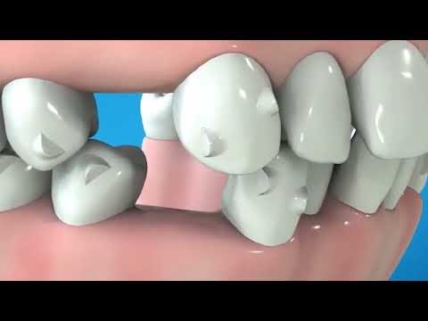 Most advanced Clear Aligner System | Invisalign® G Series of Innovation | Invisalign® G3 G4 G5 G6 G7