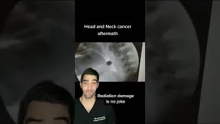 Radiation Prevents Swallowing