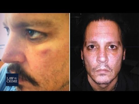 SHOCKING!!! MUST SEE!! PHOTOS of Johnny Depp's INJURIES!