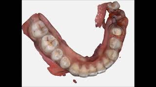 Digital impression & CAD CAM milled prosthesis in one day for basal implant