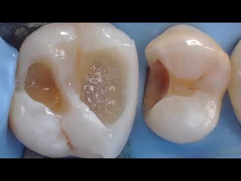 Step by step Composite Class 2 Filling Cavity