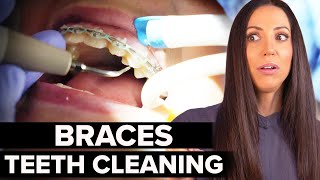 Braces Teeth Cleaning at the Dentist