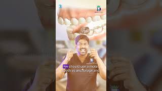 முன் பல்லில் மட்டும் கிளிப் போடலாமா? - Can we do braces only for front teeth | Denta Kings