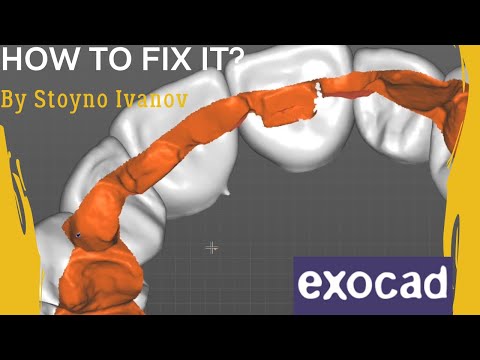 Anatomic Bridge / Problems with Crown Bottoms / Prep Line / EXOCAD