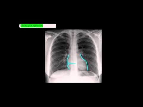 Chest X-Ray Reading Method - ABCDE [UndergroundMed]