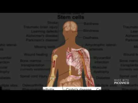 Stem Cell Transplant In India