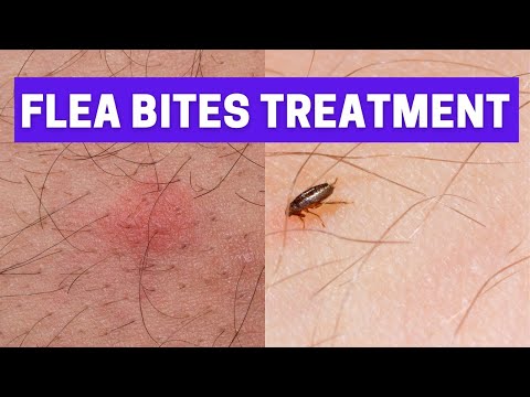 how to treat flea bites at home | ways to get rid of flea bites