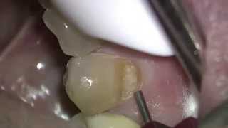Air Abrasion HD