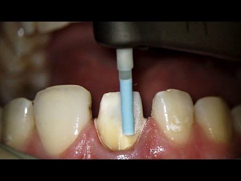 Finishing tooth preparation