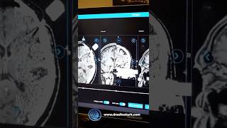All stages of Deep Brain Stimulation (DBS) Surgery for the treatment of Parkinson’s Disease