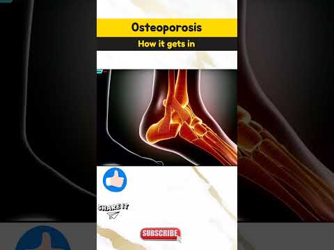 How osteoporosis affects our bone | #health #healthtips #osteoporosis