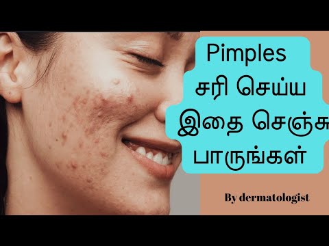 Dermatologist tips to manage acne/ pimples from home/ acne removal/ home remedies/acne cure