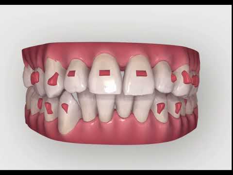 Invisalign Tooth Movement - JB White DDS Las Vegas