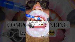 Composite bonding by Dr. Matt, completed without any drilling or injections! #compositebonding