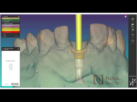 How to design your NobelProcera® Ti Abutment using exocad™