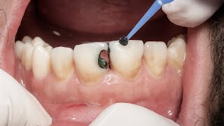 Composite Restoration for Anterior Teeth: Step-by-Step Procedure 🦷🦷