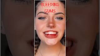 Bleeding Gums: Signs of Serious Health Issues