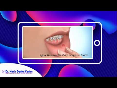 Do's and Dont's After Getting Braces Treatment | Dental Tips for Braces | Dr. Hari's Dental Centre
