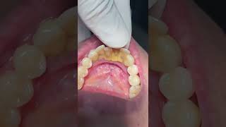 Teeth mobility #dentistteeth #dentist #dentaltreatment