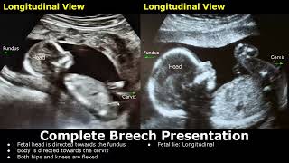 Fetal Presentations Ultrasound Images | Cephalic/Breech/Frank/Footling/Funic Fetus | Fetal Lie USG