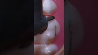 Step-by-Step molar crown prep. #dentistry #dentaleducation #MolarPrep