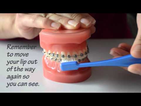 How do I brush with braces?