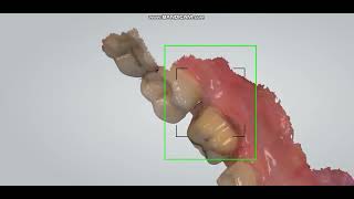 Intra oral scanner 3 shape for digital impression#digitaldentistry