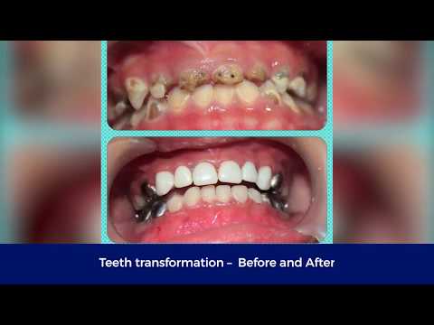 Early childhood cavities | Teeth Transformation | Dr. Hari's Dental Centre | Chennai