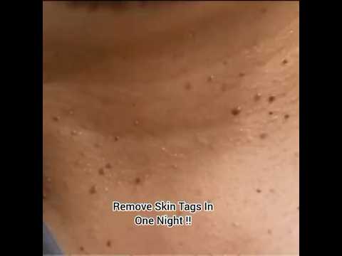 Get rid of ugly skin tags in one night #youtubeshorts #remedies