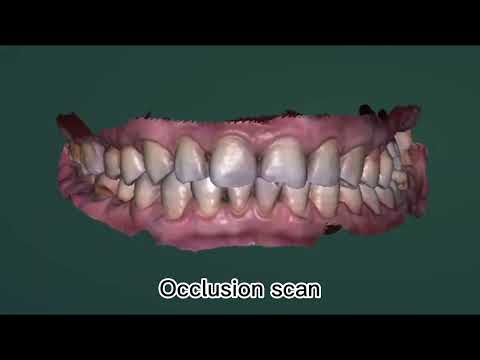 Launca Case Show - Implant case shared by Dr.Wan