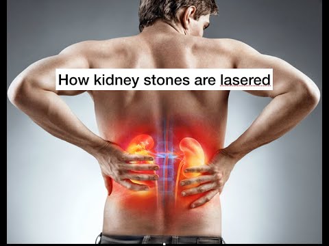 How are kidney stones lasered