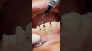 Composite restoration for anterior teeth #dentist