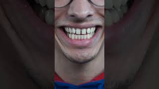 my braces journey begins!
