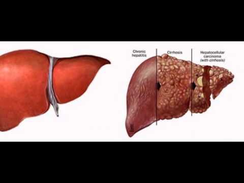 Liver Hepatitis Symptoms