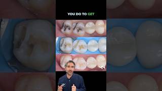 Why are simple direct restorations the most important in Biomimetic dentistry? 🤔 #dentist #dental