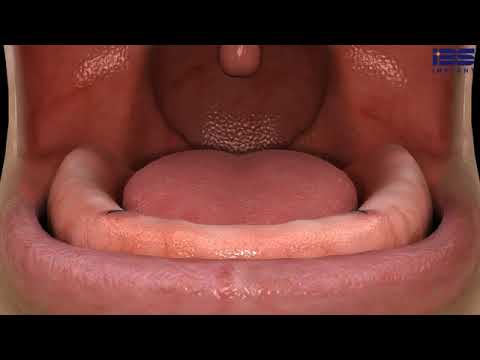 Magic Motion Overdenture System English
