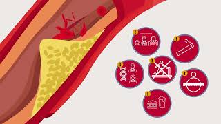 Cholesterol and heart disease | Heart Foundation