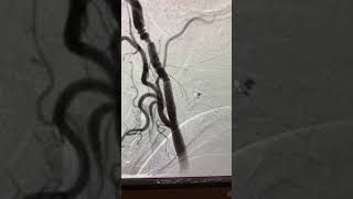 Carotid stenting of a soft plaque stenosis