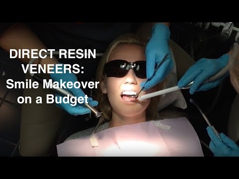 Smile Makeover on a Budget: Direct Resin Veneers